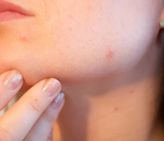 TRATAMIENTO-ACNE Piel con imperfecciones – Tratamientos dermatológicos Talavera